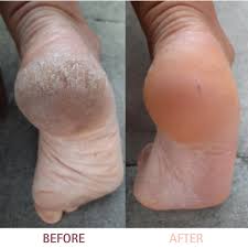 Electric Foot Callus Remover Pedicure Tool for Smooth Soft Feet